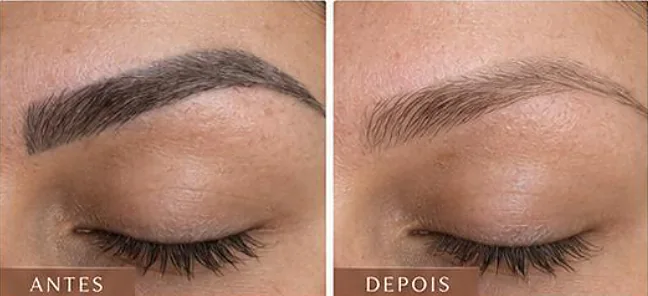 Antes e depois ilustrativo, Erase Pigment