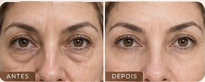 Antes e depois ilustrativo, K Eyes Lift